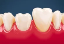 Photo of Лечение пародонтита: важность профилактики